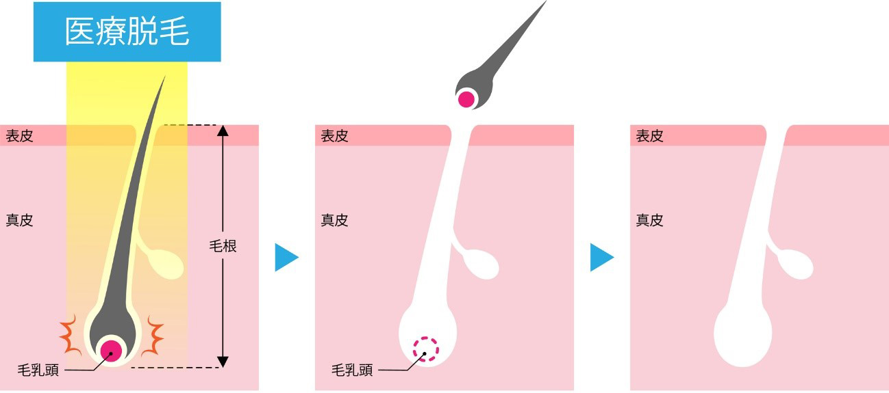 医療レーザー脱毛とは