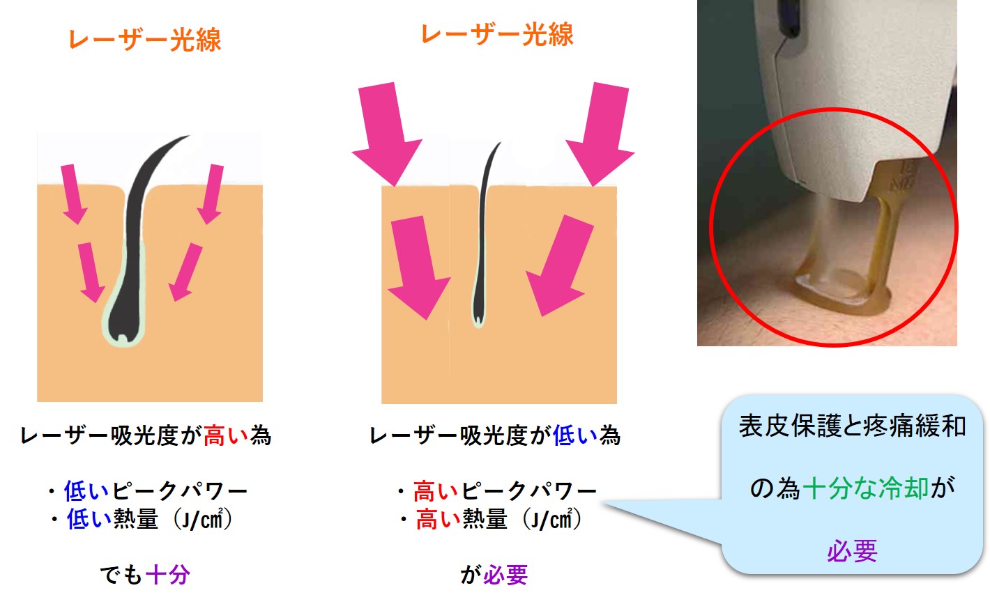 千葉県流山市・柏市・南流山でジェントルマックスプロプラスを使用した医療脱毛を提供している南流山内視鏡おなかクリニックの医療レーザー脱毛イメージ図