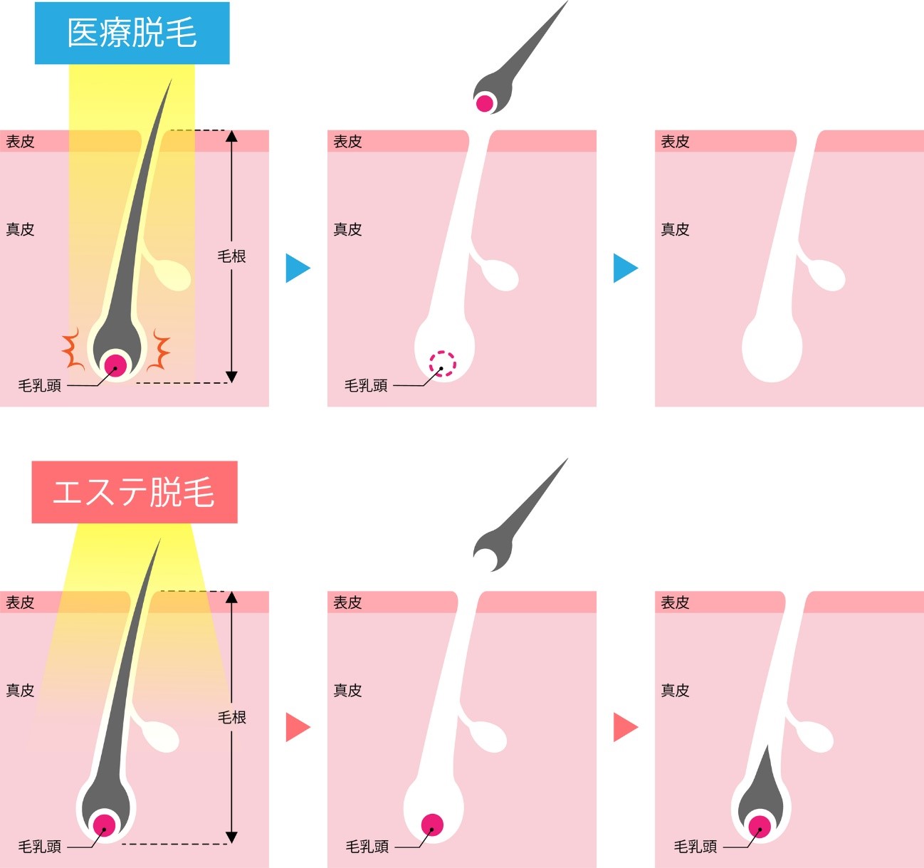 エステ脱毛との違い