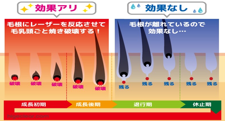 千葉県流山市・柏市・南流山でジェントルマックスプロプラスを使用した医療脱毛を提供している南流山内視鏡おなかクリニックの医療レーザー脱毛、毛周期イメージ図